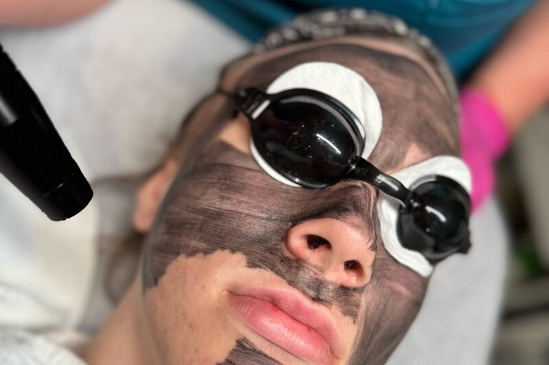 Carbon Laserpeeling