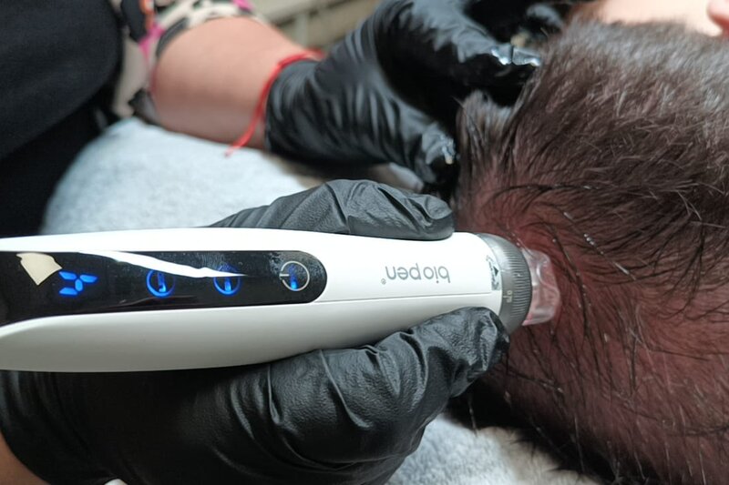 Naaldmesotherapie