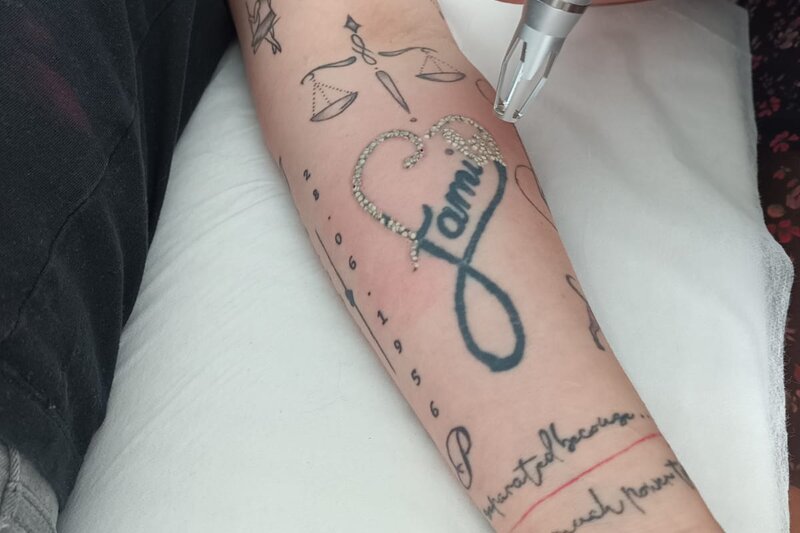 Tatoeage Verwijderen